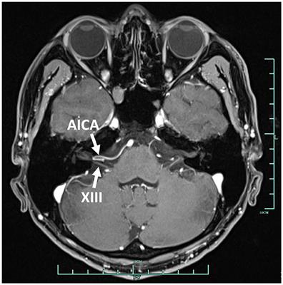 Vestibular paroxysmia associated with congenital vascular malformation: A case report